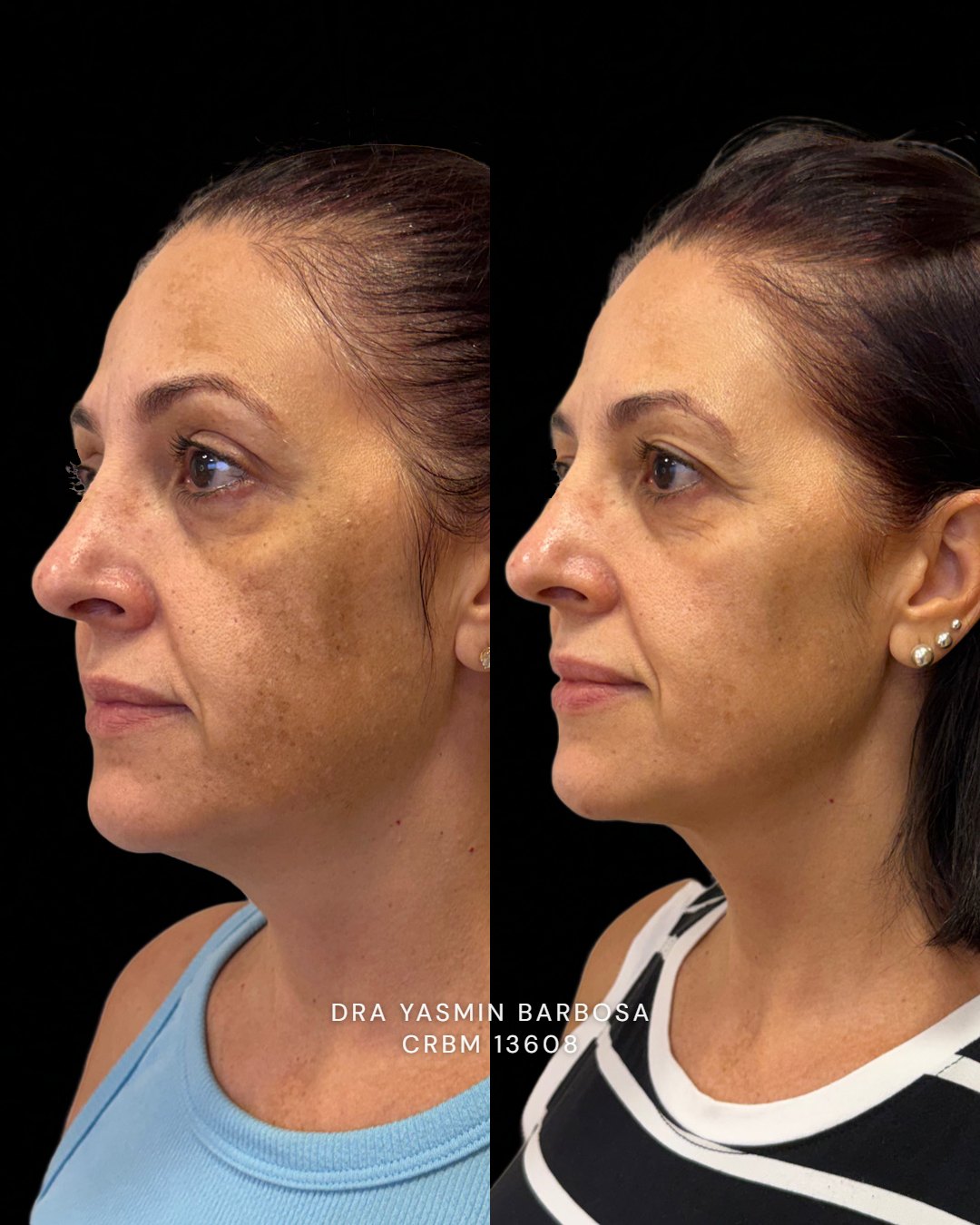 Paciente com melasma antes e depois do tratamento